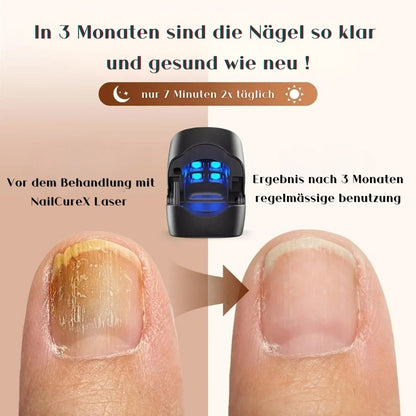 NailCureX Laser - deine effektive Lösung gegen Nagelpilz !